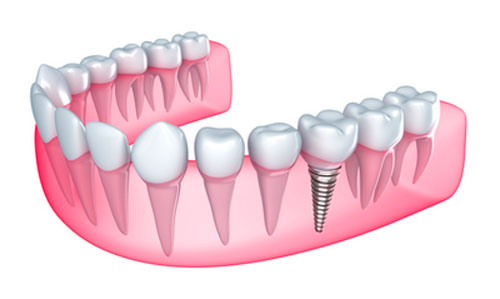 Dental Implant Treatment