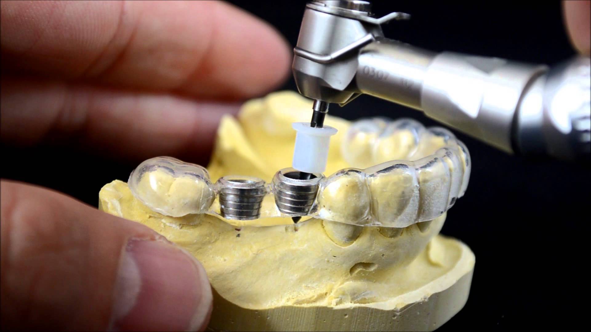 Les implants dentaires valent-ils la peine d’être dépensés ?