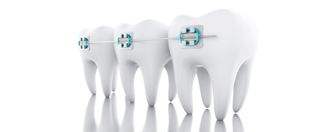 Braces Woodland Hills Can Address a Variety of Dental Issues