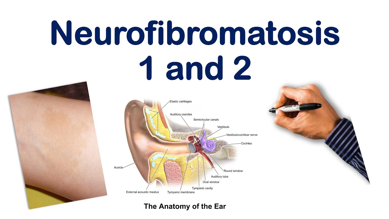 Neurofibromatose infantile